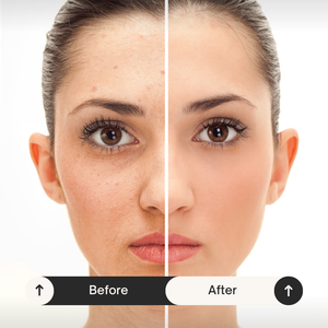 Lynnora Red Light Therapy Gezichtsmasker