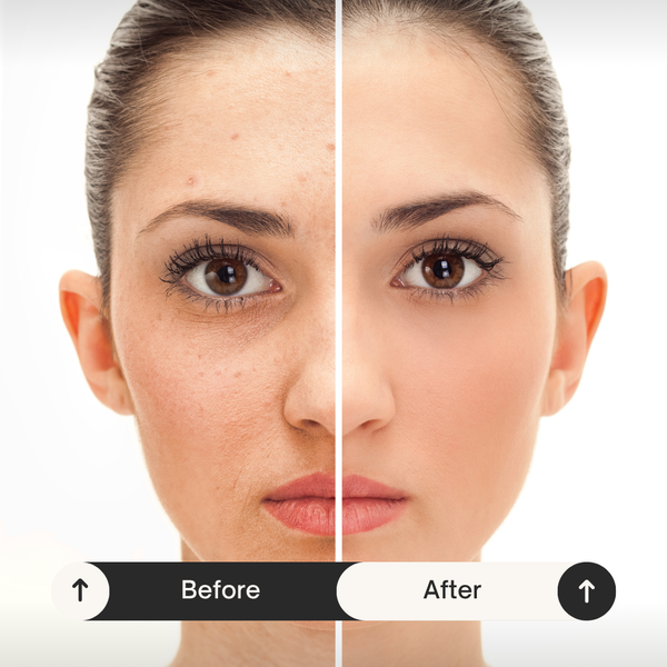 Lynnora Red Light Therapy Gezichtsmasker